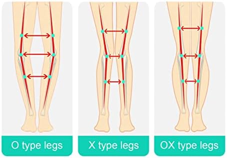 Cinturão de correção de pernas Yuyte o/x, corretor de perna de poliuretano, corretor de corretor, pernas ajustáveis ​​Corrector de correção