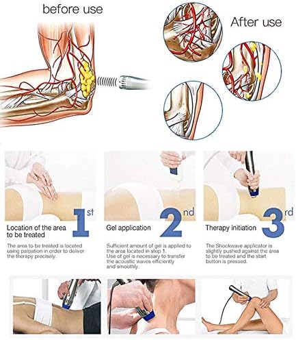 Máquina de terapia de ondas de choque extracorpórea de NSWD para DE, massageador de onda de choque eletromagnético eficaz