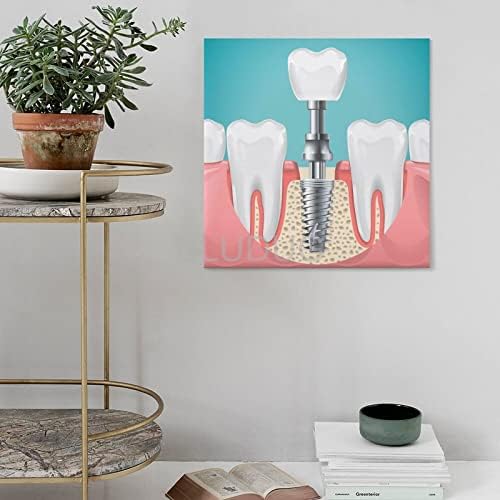 BLUDUG Dental Hospital Poster Implante Dental Poster Dental Canvas Pintura Arte da parede Poster para quarto Decoração