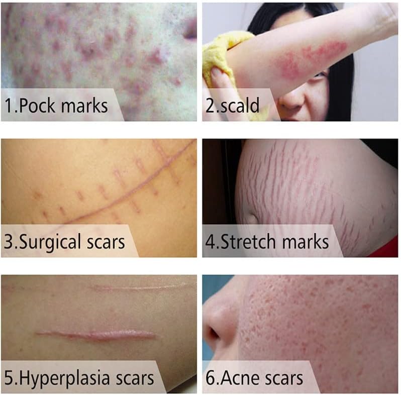 Remoção de cicatrizes Tratamento de creme estrias queimaduras de acne Removedor de acne Crolar cicatrizes suavizando os produtos de beleza do corpo de clareamento da pele
