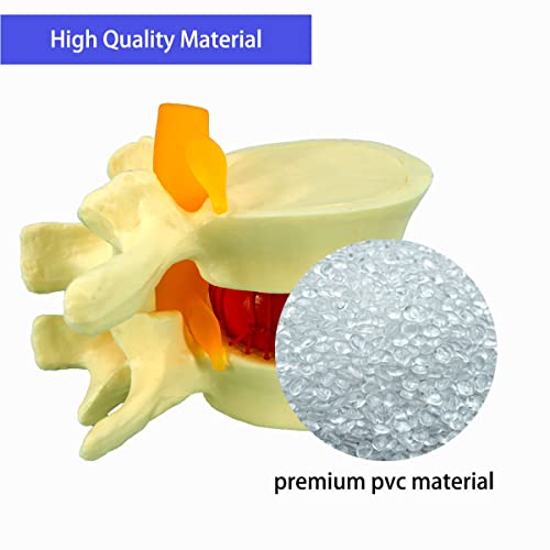 VEIPHO Modelo de hérniação de disco lombar humano, 1,5 vezes o modelo de hérnia de disco lombar de tamanho de vida, modelo de hérnia de disco lombar humano para ensinar, aprender, demonstrar