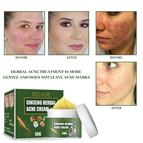 Ginseng Herbal Acne Removendo creme, remova profissionalmente marcas de acne, hidratam suavemente, refrescante e não oleoso, melhorando a pele sensível propensa a acne 50g