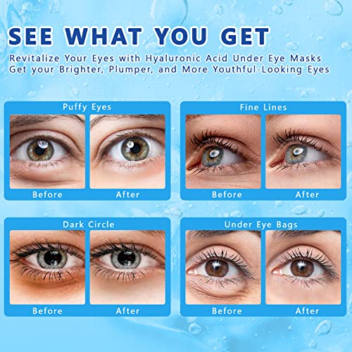 Sob remendos oculares para círculos escuros e tratamento de inchaço, 60pcs de ácido hialurônico antienvelhecimento sob máscara ocular,