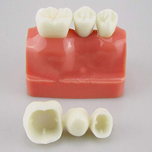 Modelo de análise para o modelo de dentes de demonstração de ponte de implante dental para educação m2017