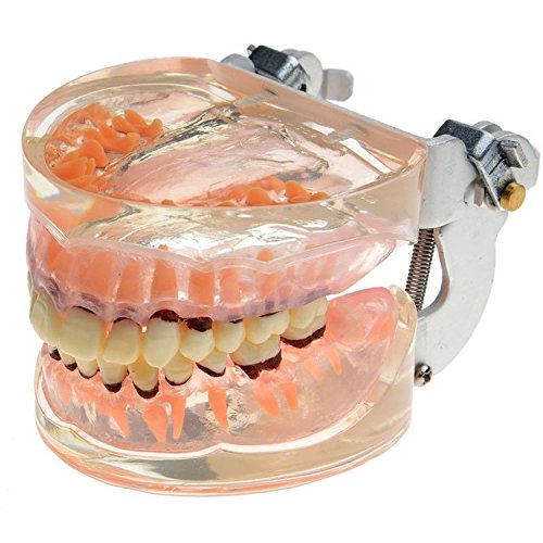 Doc.Royal Dental Study Transparent Adult Pathological Periodontal Dentes Modelo 4017