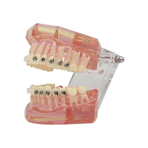 Modelo de Estudo Ortodôntico Dentalmall Dental com aparelho de cerâmica de cerâmica de metal M3003